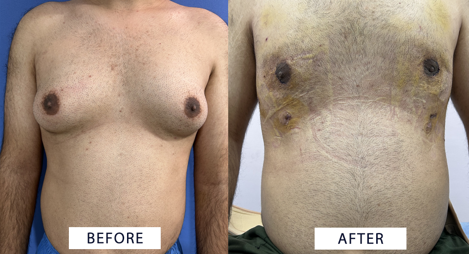 Gynecomastia Surgery